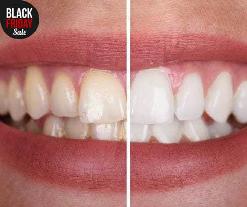 WhiteMagic™ | geniet van een stralend witte lach zonder risico's! |Alleen vandaag 1+1 Gratis