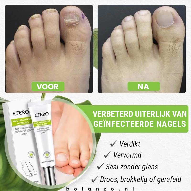 1+1 Gratis | Fungus Repair™️ | Weg met nagelschimmel
