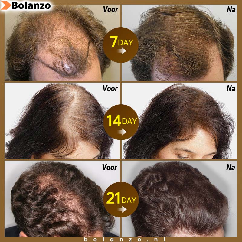 BioPurc™ Haargroei olie (1+1 Gratis)