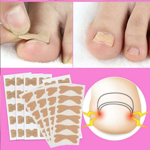 EasyPlaster™ | Corrigerende pleisters voor mooie en gezonde nagels | 25 + 25 Gratis