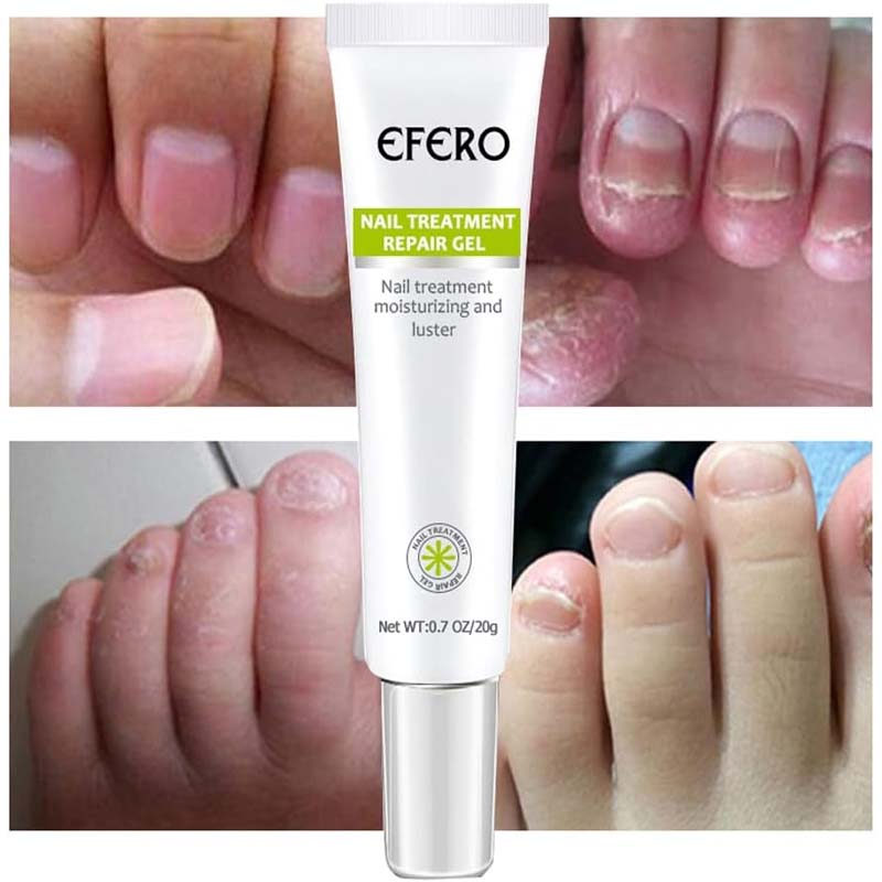 1+1 Gratis | Fungus Repair™️ | Weg met nagelschimmel