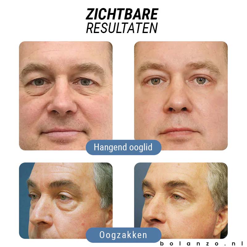 BrightLift™ - Liftende ooggel (1+1 GRATIS)