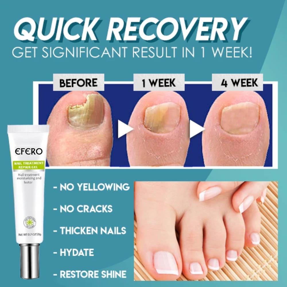 NailFix™ Snel en effectief resultaat!